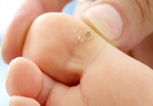 طرق علاج عين السمكة