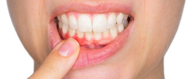 علاج التهاب اللثة سريع المفعول